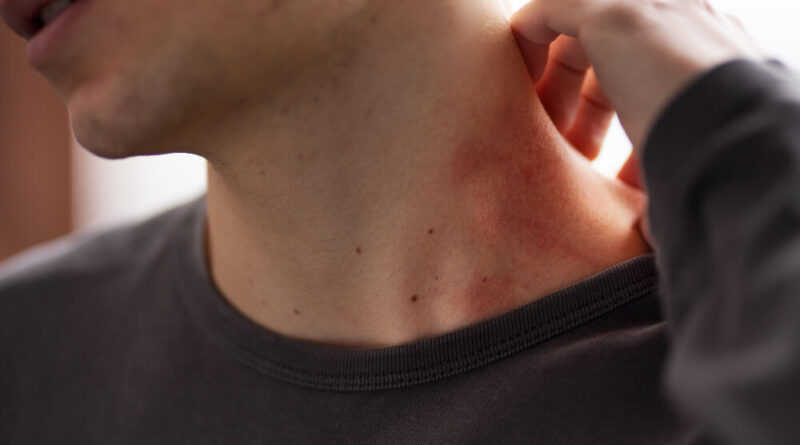 Acantose nigricans: